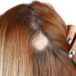 How Can I Grow Hair on Bald Spots Naturally?
